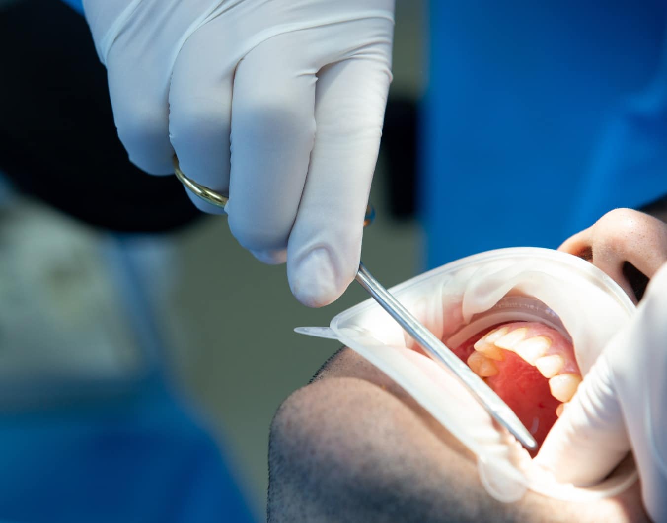 Qu’est-ce qu’une reconstruction implantaire dentaire ? | Dr Temstet | Paris