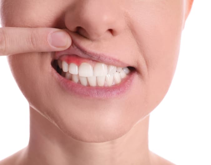 Comment repérer une gingivite ? | Dr Temstet | Paris